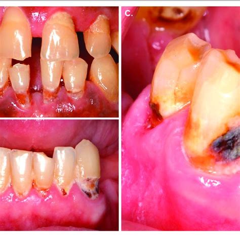 Clinical Appearance Of The Carious Root Lesions Showing A Massive