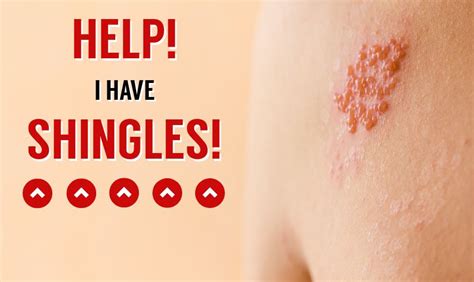Herpes rash dermatitis is a condition of inflamed skin. Help! I have Shingles! - U.S. Dermatology Partners | Blog