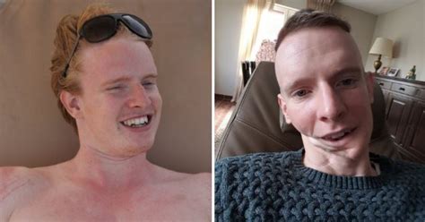 Surgeons Rebuild Cancer Survivor Lorenz Dries Jaw With Fat From His