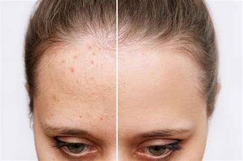 Premium Photo Cropped Shot Of Young Woman Face Before After Acne Treatment On Face Pimples Red