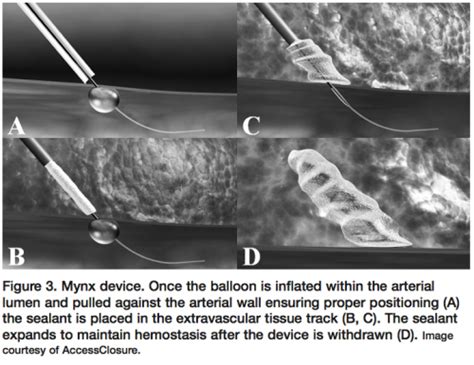 Review Of Vascular Closure Devices