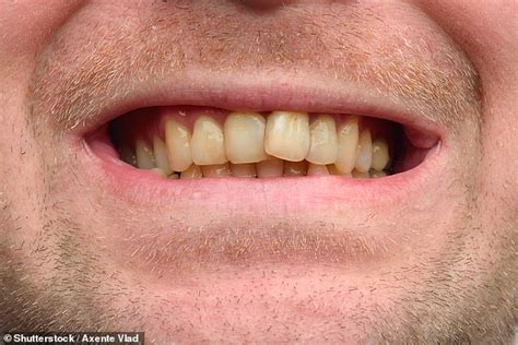 Research Reveals Americans Think British People Have Bad Teeth And