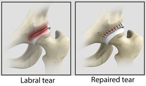 Hip Labral Repair Florida Ortho Care
