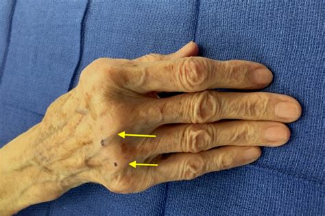 Extensor Tendon Subluxation Finger Hand Surgery Source