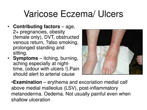 Ppt Varicose Eczema Ulcers Powerpoint Presentation Free Download