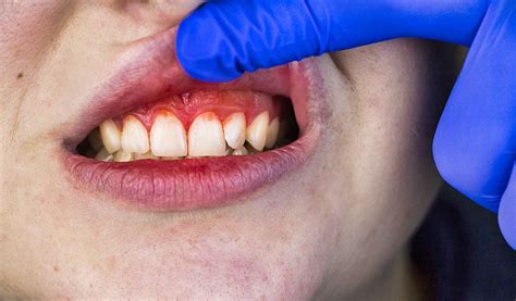 Gum Disease Gingivitis Periodontitis Causes Stages Symptoms And