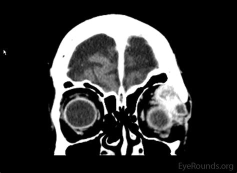 Adenoid Cystic Carcinoma Of The Lacrimal Gland