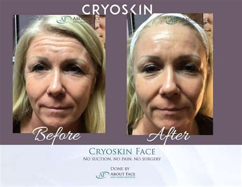 Cryoskin Facial Slimming Machine Results Reviews And Cost