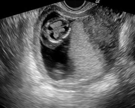 Hydrops fetalis | Image | Radiopaedia.org