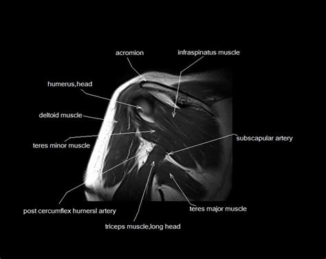 Located inferior to the knee are a number of muscles that move the ankle, foot, and toes. MRI shoulder anatomy | shoulder coronal anatomy | free ...