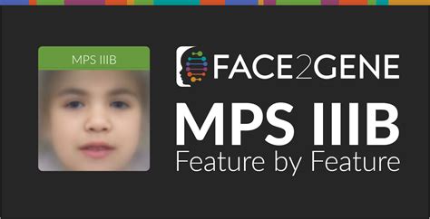 Facial Analysis Discoveries For Sanfilippo Syndrome B Mps Iiib Fdna