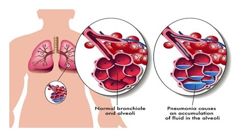 Siapa yang ada masa untuk sakit tekak? Ubat Antibiotik Untuk Sakit Tekak - Kerja Kosl