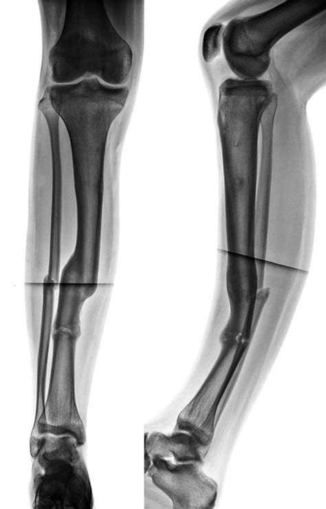 Ap And Lat Radiographs 3 Months After Long Leg Cast Immobilization