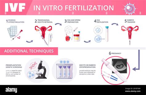 Colored In Vitro Fertilization Ivf Flat Infographics With Steps Of