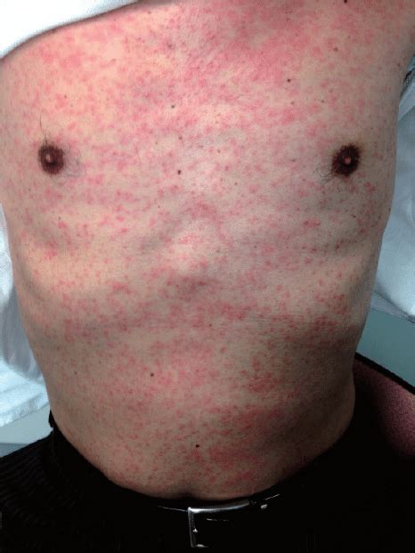 Maculopapular Rash On The Trunk In A Case Of Imported Zikv Infection