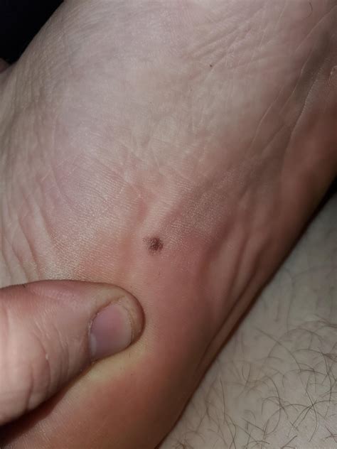Does This Mole On The Bottom Of My Foot Look Like Melanoma Rmelanoma