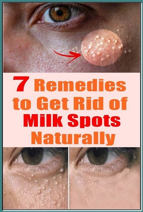 7 Remedies To Get Rid Of Milk Spots Naturally In 2022 Remedies