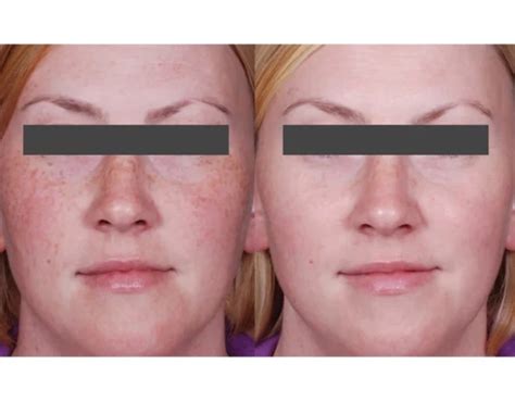 Best Melasma Skincare And Pigment Inhibitors Cutis Clinic