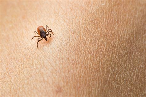 Normal Tick Bite Pictures