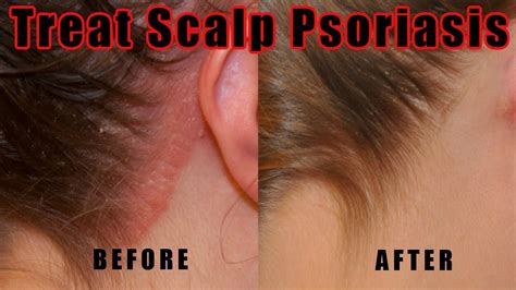Psoriasis Scalp Treatment