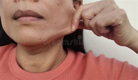 The Flabby Wrinkled Beside The Cheeks Stock Image Image Of Skin