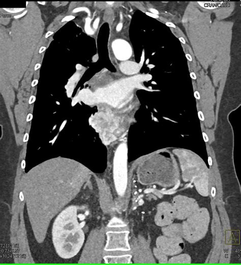 Metastatic Renal Cell Carcinoma To The Mediastinum Kidney Case