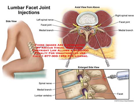 Lumbar Facet Joint Injections