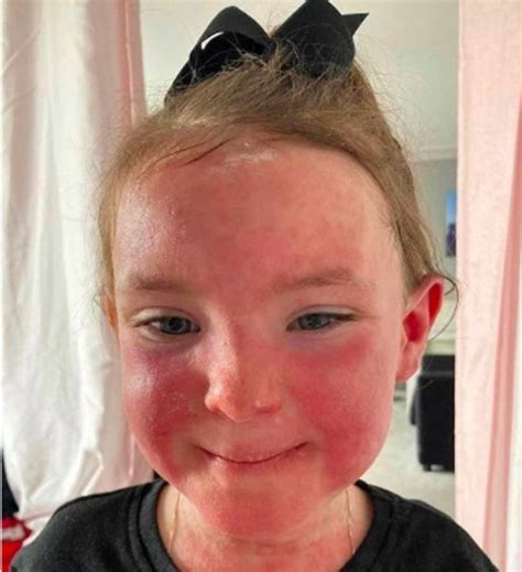 Scotland Mum Warns Parents Of Strep A Symptom That Looks Like Sunburn