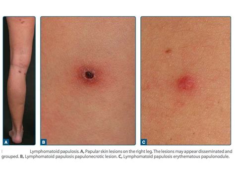 Cutaneous T Cell Lymphomas