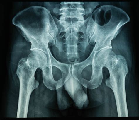 Hip Replacement Patient Blames Injuries On Defective Lfit V40 Femoral
