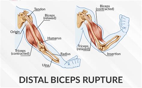 Distal Biceps Rupture Dr Saurabh Aggarwal