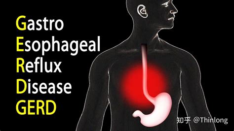 反胃酸怎么办低碳生酮和胃食管反流GERD的关系 知乎