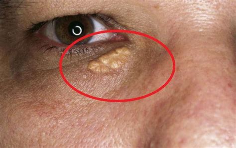 How To Treat Xanthelasma Or Cholesterol Deposits Around The Eyes In