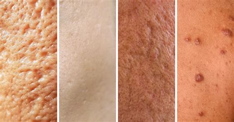 Types Of Acne Scars And How We Can Help Melior Clinics