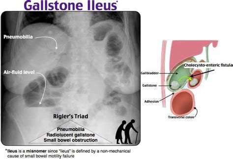Gallstone Ileus New