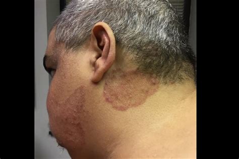 Clinical Challenge A Moderately Itchy Rash On The Neck And Cheek Mpr