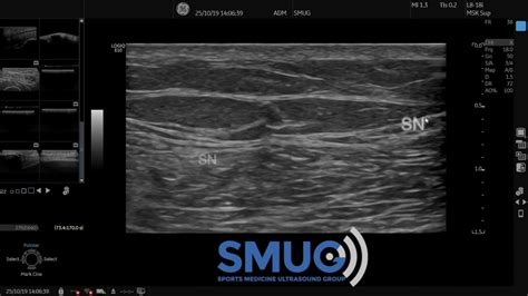 Sural Nerve Ultrasound Imaging Youtube