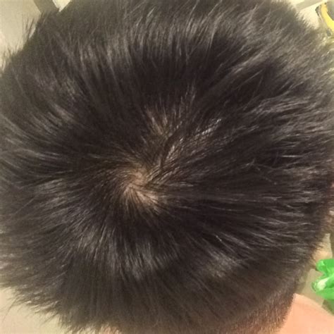 Is It Early Sign Of Balding