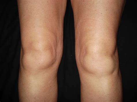 What Causes Swelling Knee And Pain Video Free Online First Aid Course