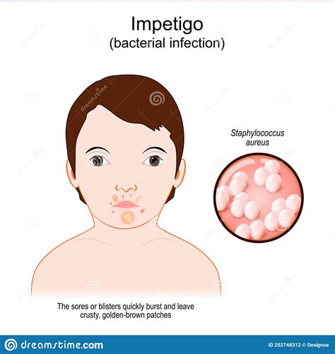Impetigo Face Baby With A Skin Infection Stock Vector Illustration