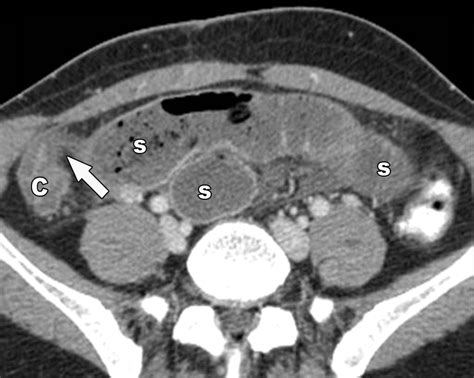 Small Bowel Obstruction What To Look For Radiographics