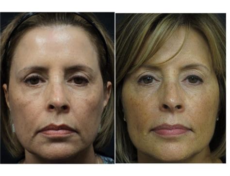Before and After Photos - Central Florida Dermatology Associates