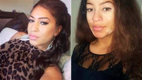 Woman With Vitiligo Launches Make Up Brand After Hiding Condition