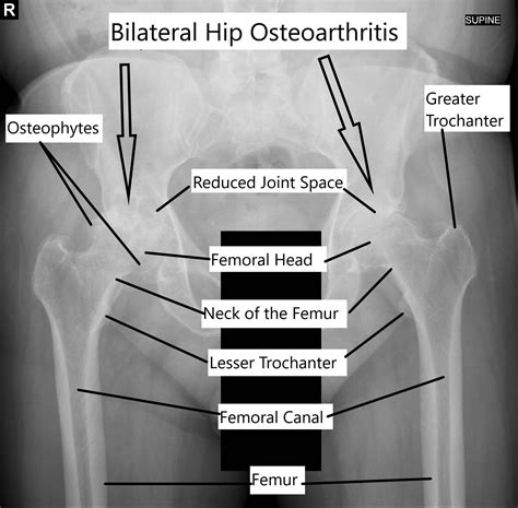 Bilateral Simultaneous Total Hip Replacement Complete Orthopedics