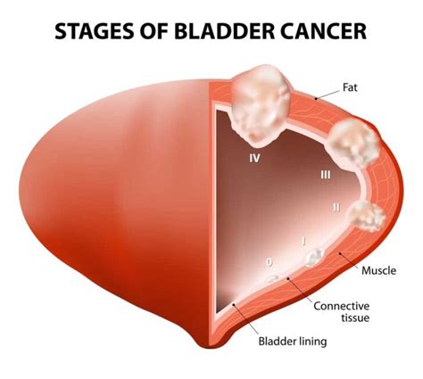 14 Scary Symptoms Of Bladder Cancer Every Woman And Man Needs To Know