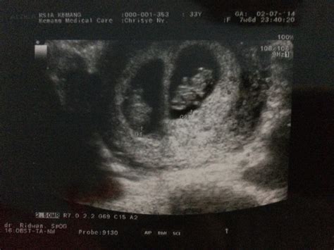 Jika mama masih bingung, jangan sungkan untuk menanyakan kepada. Hasil Usg Bayi 2 Bulan - Baby Love