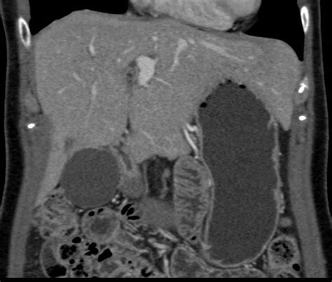 Normal Small Bowel On Ct Enterography With Volumen Small Bowel Case