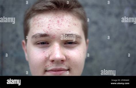 Teenage Boy With Puberty Acne Problem Looking At Camera Stock Video