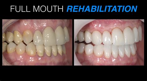 Full Mouth Rehabilitation Orasurge Dental Clinic