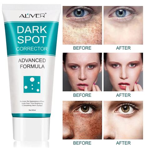 Buy Dark Spot Remover For Facedark Spot Correctorfreckle Remover Creamskin Lightening Cream